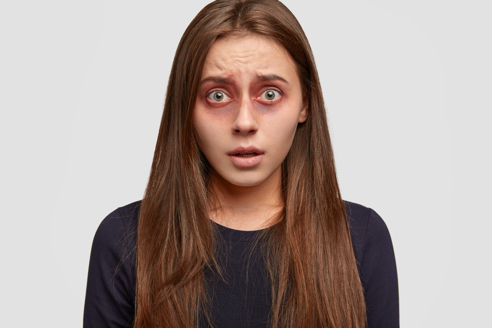 How to Reduce Dark Circles Naturally at Home